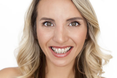 The Truth About Adult Braces