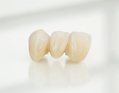 What Is A Dental Bridge?