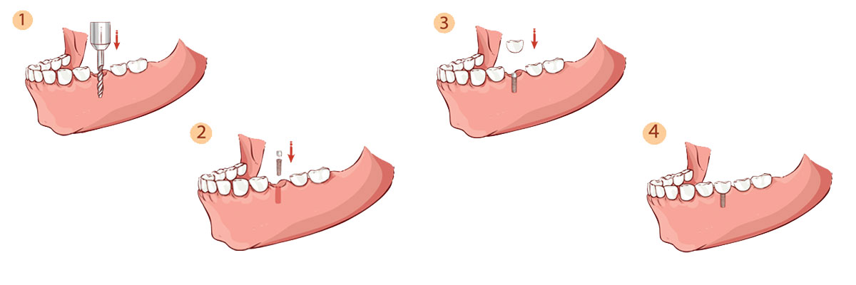 Sylmar The Dental Implant Procedure