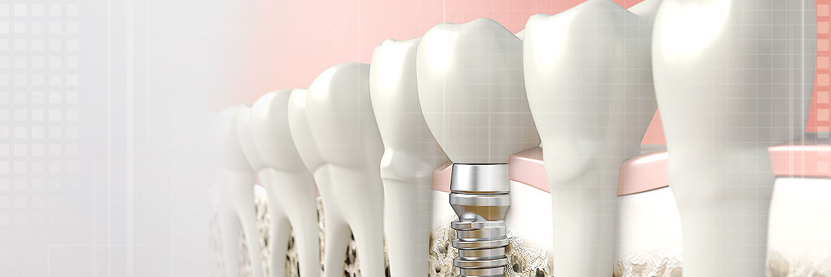 Sylmar Implant Dentist