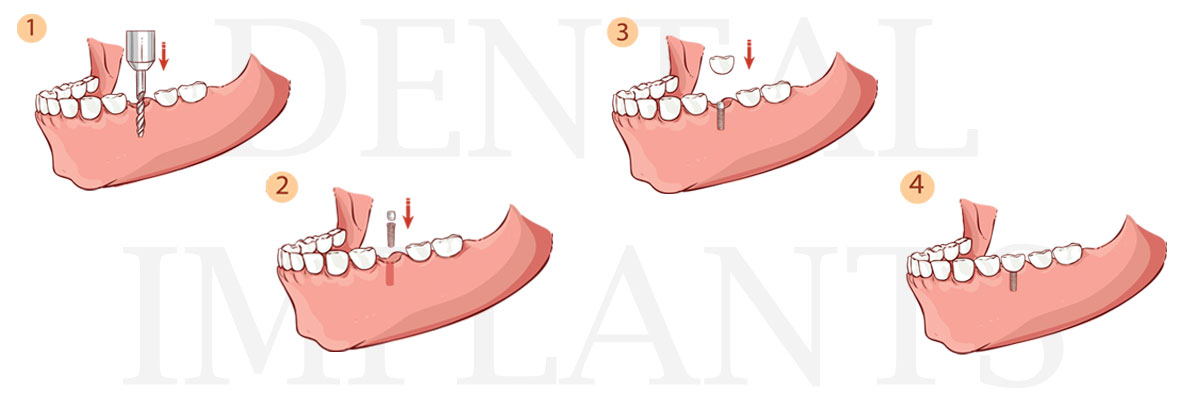 Sylmar The Difference Between Dental Implants and Mini Dental Implants