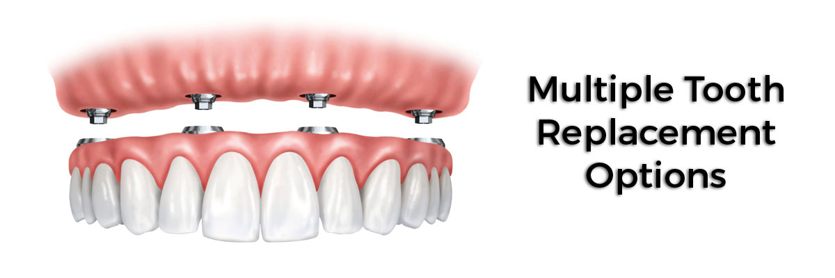 Sylmar Multiple Teeth Replacement Options