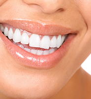 Teeth Whitening Services Sylmar, CA