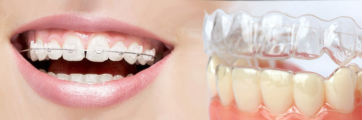Sylmar Which is Better Invisalign or Braces