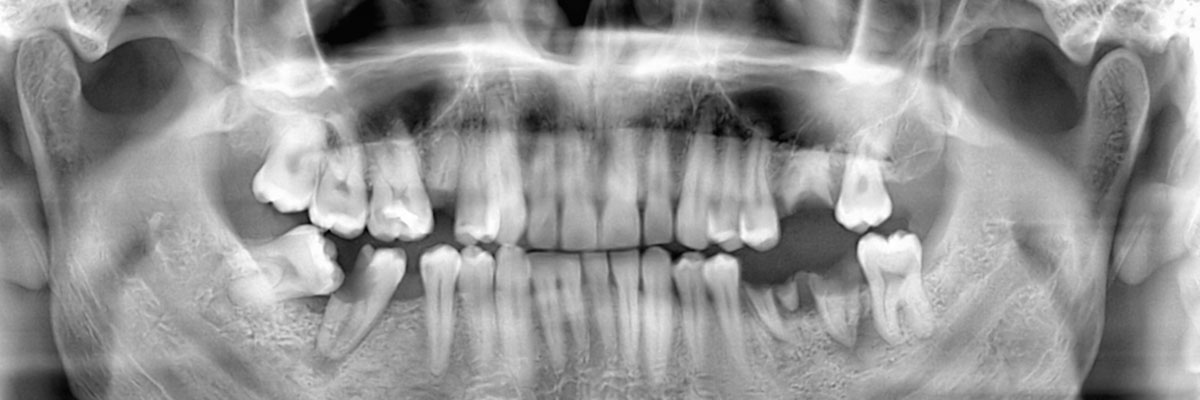 Sylmar Wisdom Teeth Extraction